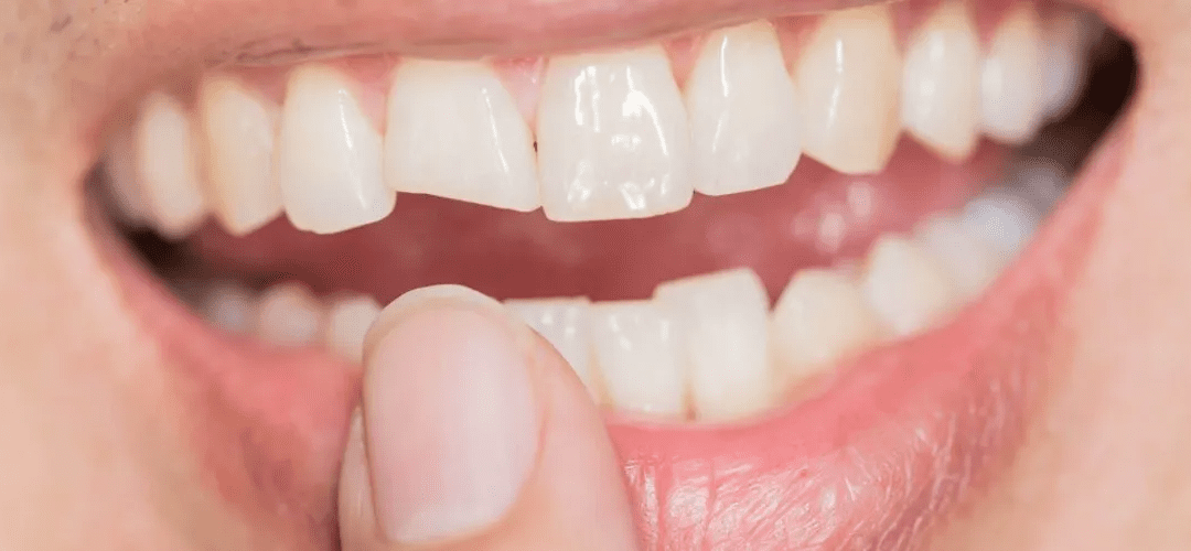 Broken Tooth? Here’s How to Manage Until You See Your Dentist