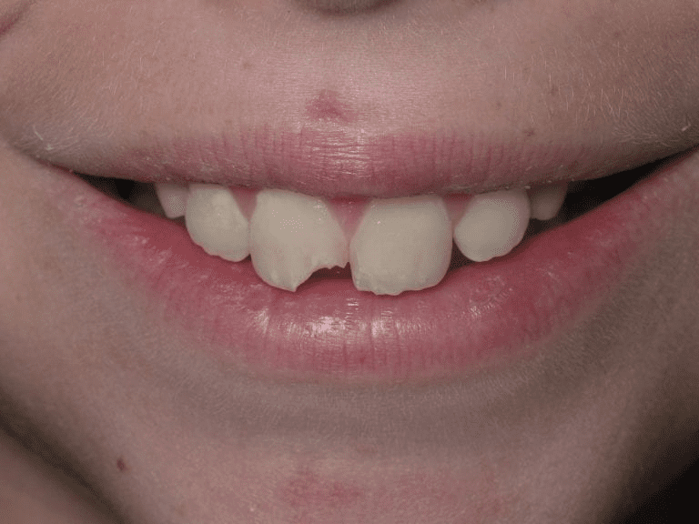 Chipped Tooth? Here’s What You Should Do Immediately